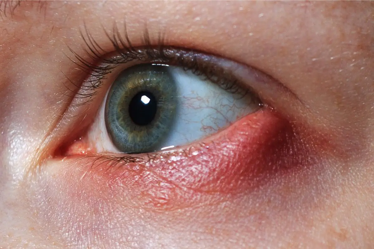 Ojo con orzuelo