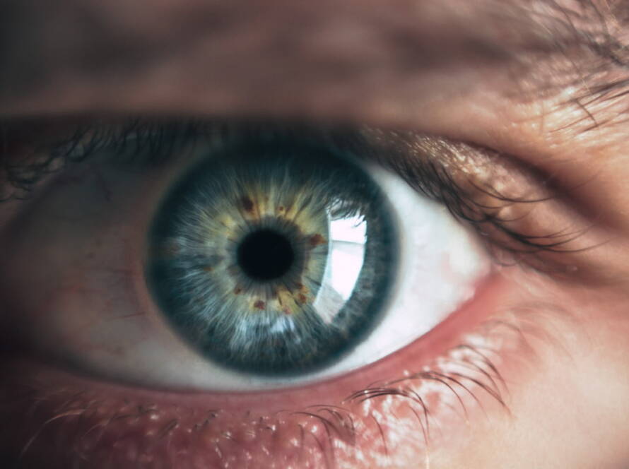 edema corneal
