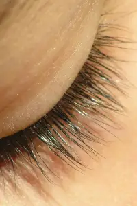 Síntomas del ojo seco o blefaritis